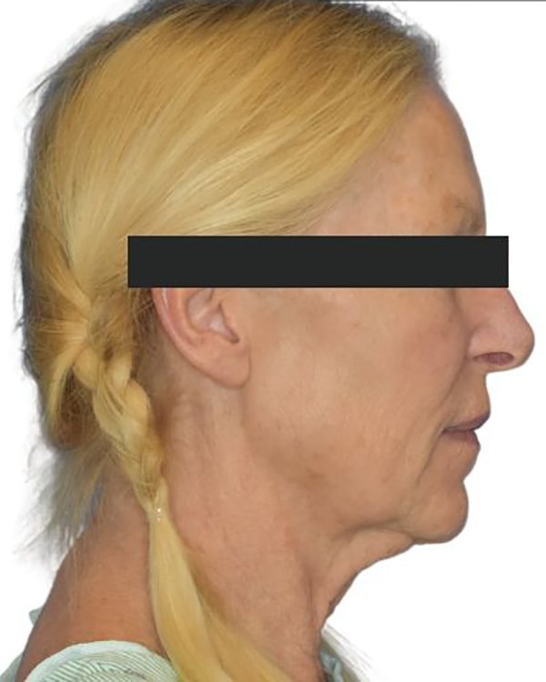 Facelift Before & After Photo Patient 09 Thumbnail