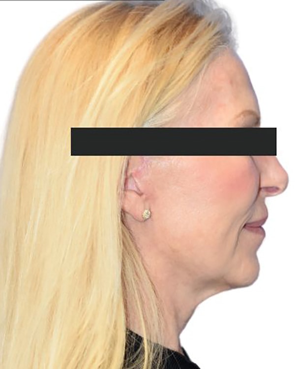 Facelift Before & After Photo Patient 09 Thumbnail