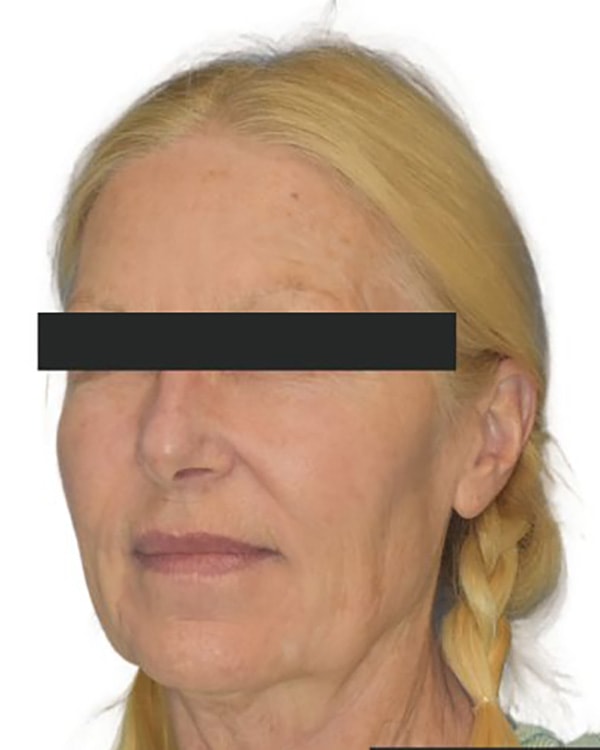 Facelift Before & After Patient 09