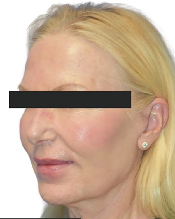 Facelift Before & After Photo Patient 09 Thumbnail