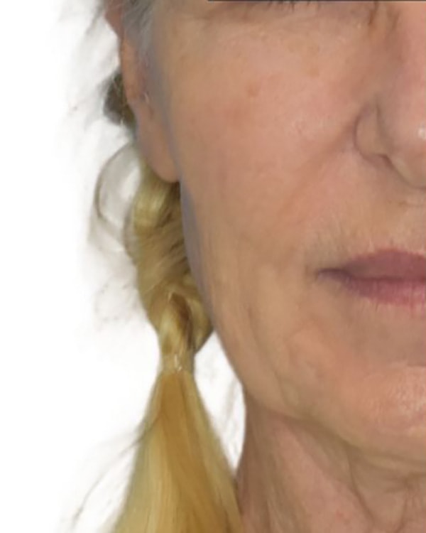 Facelift Before & After Patient 09