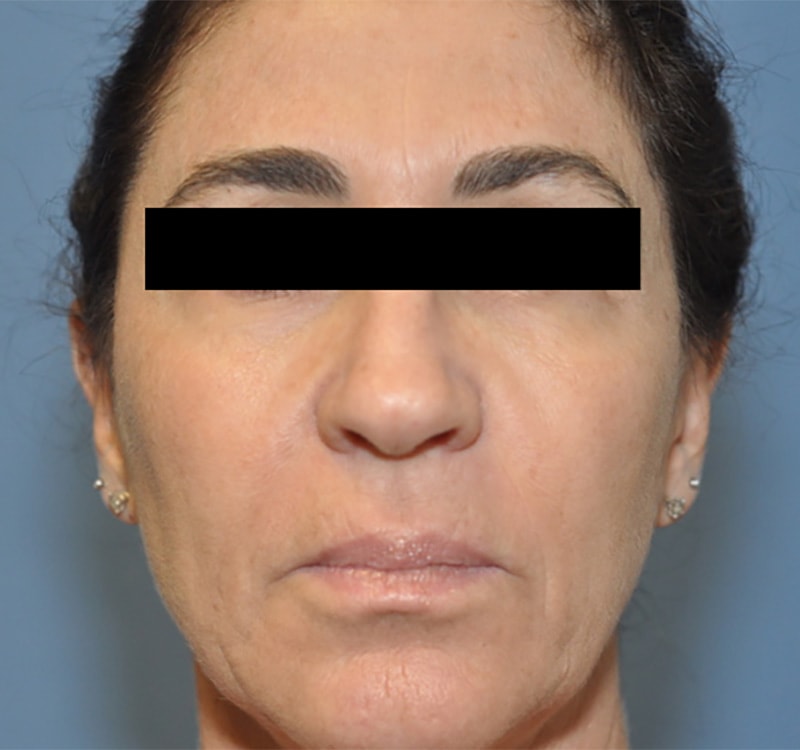Facelift Before & After Patient 10