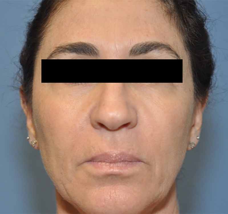 Facelift Before & After Photo Patient 10 Thumbnail