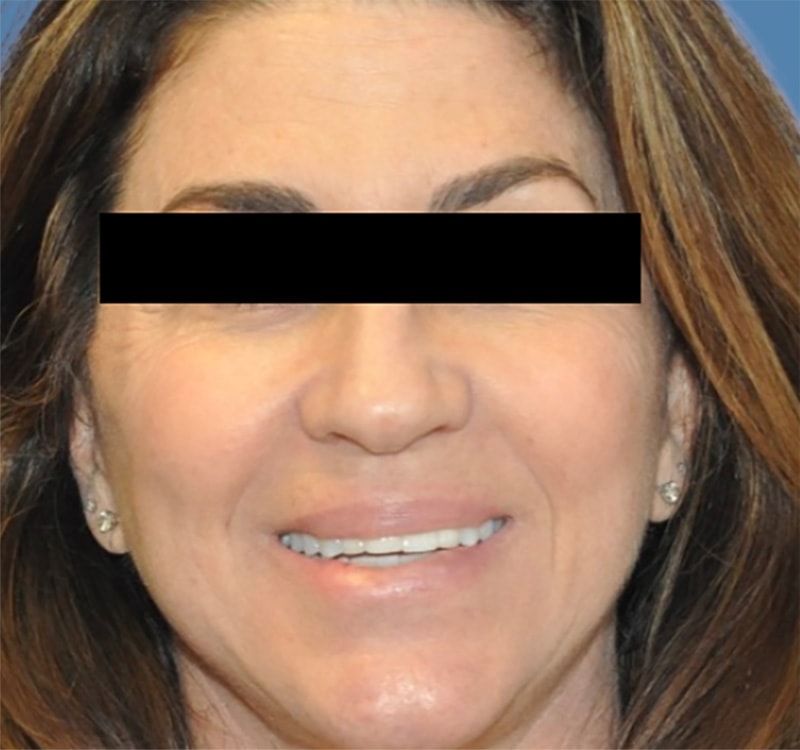 Facelift Before & After Photo Patient 10 Thumbnail