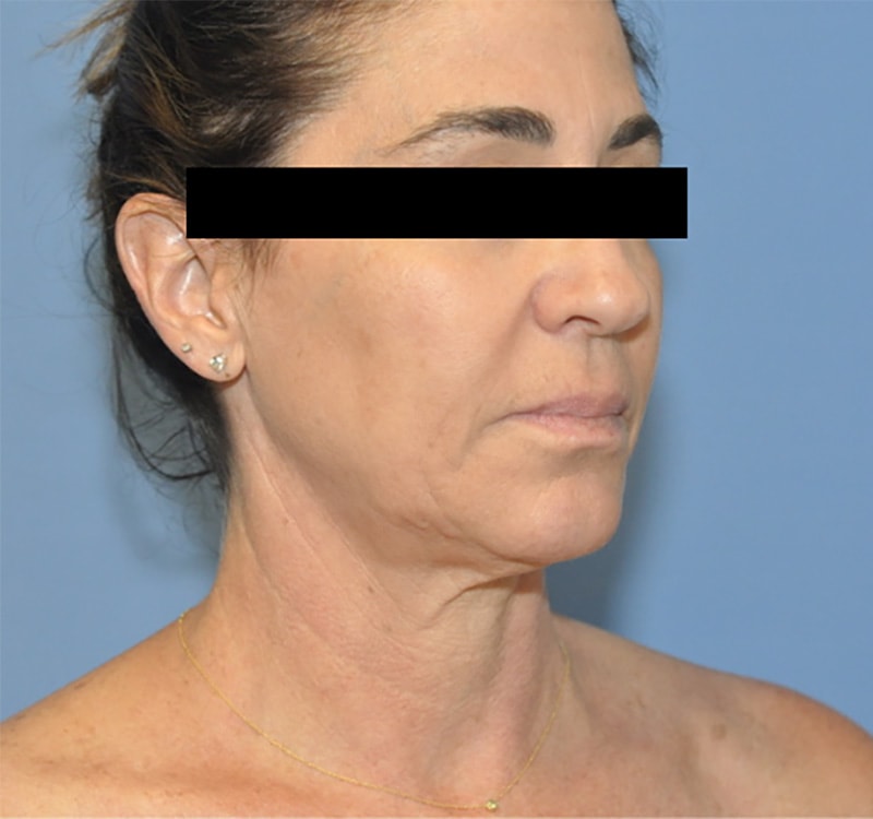 Facelift Before & After Patient 10