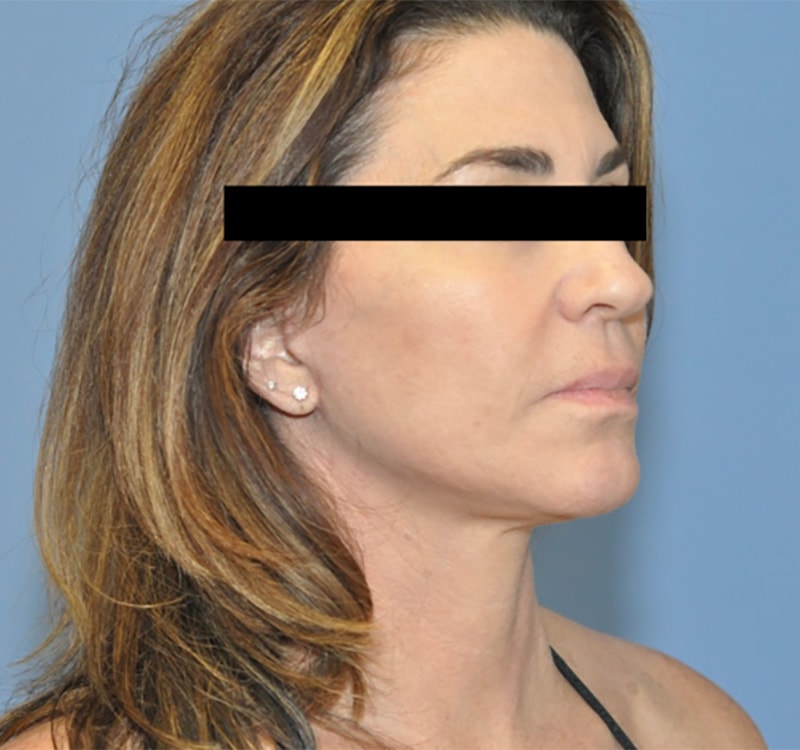 Facelift Before & After Photo Patient 10 Thumbnail