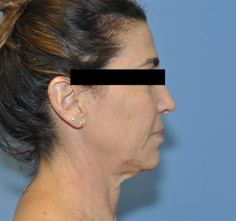 Facelift Before & After Photo Patient 10 Thumbnail