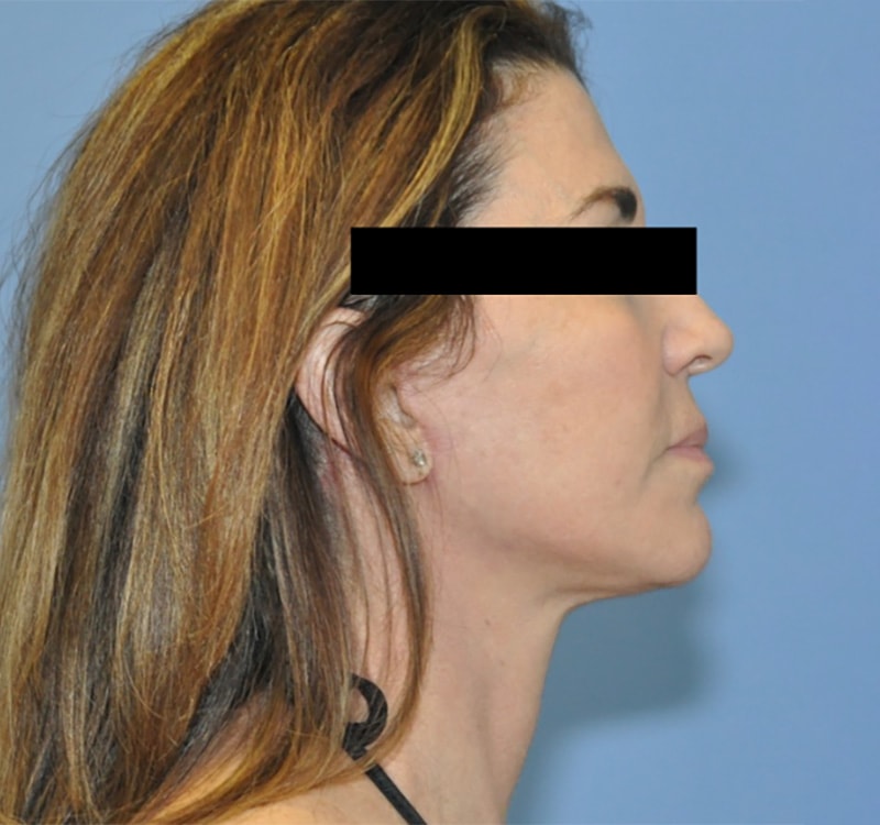 Facelift Before & After Patient 10