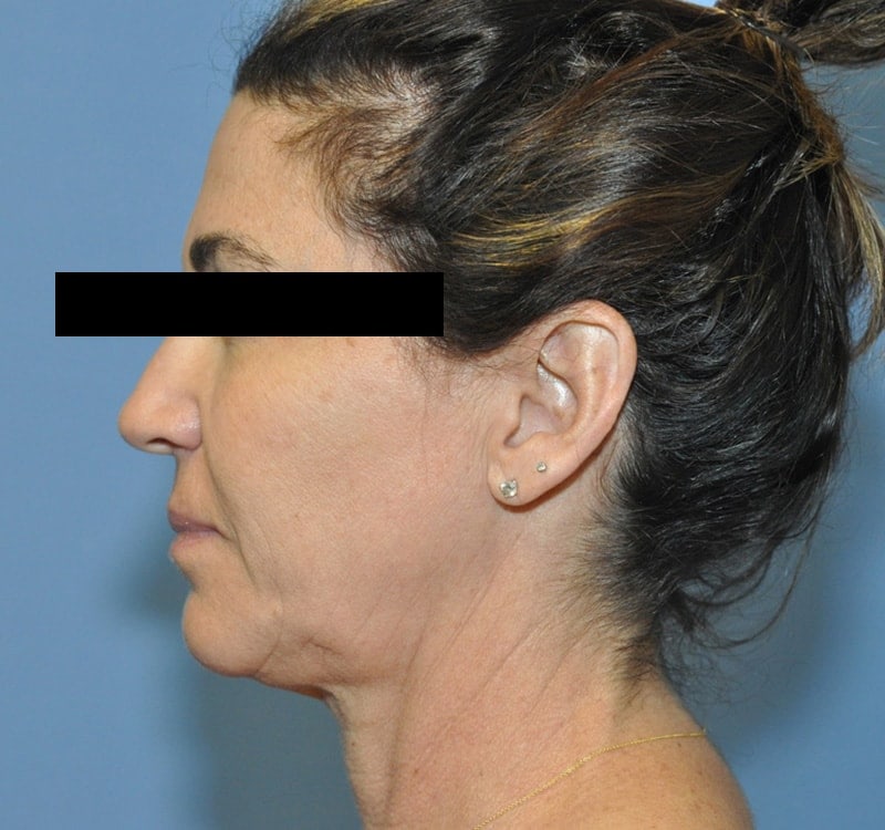 Facelift Before & After Patient 10