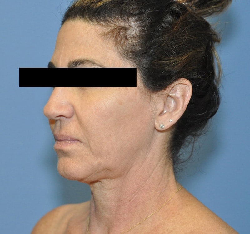 Facelift Before & After Patient 10