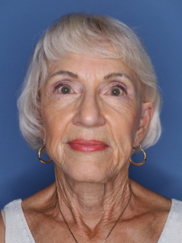 Facelift Before & After Patient 11