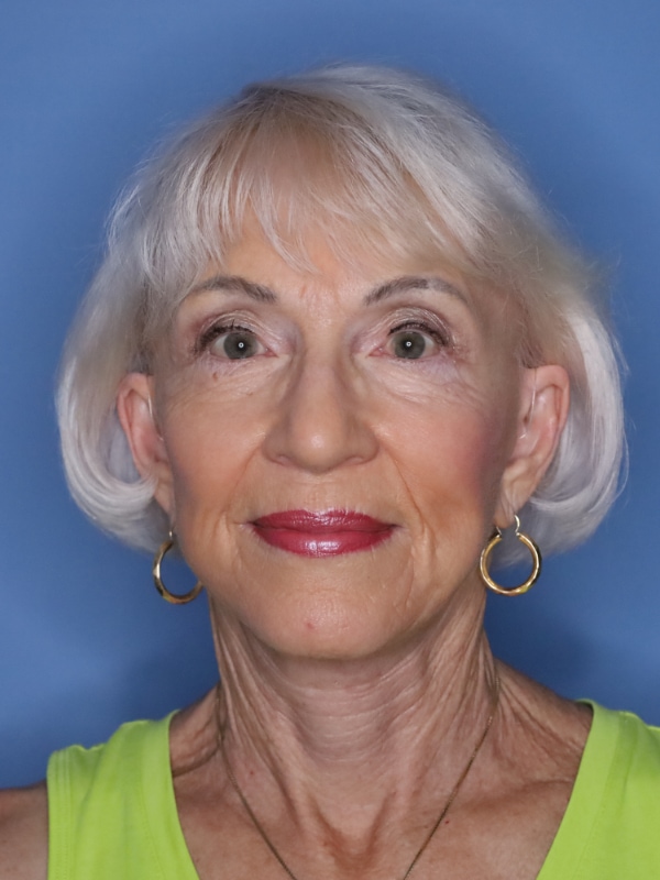 Facelift Before & After Patient 11