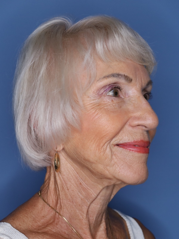 Facelift Before & After Patient 11