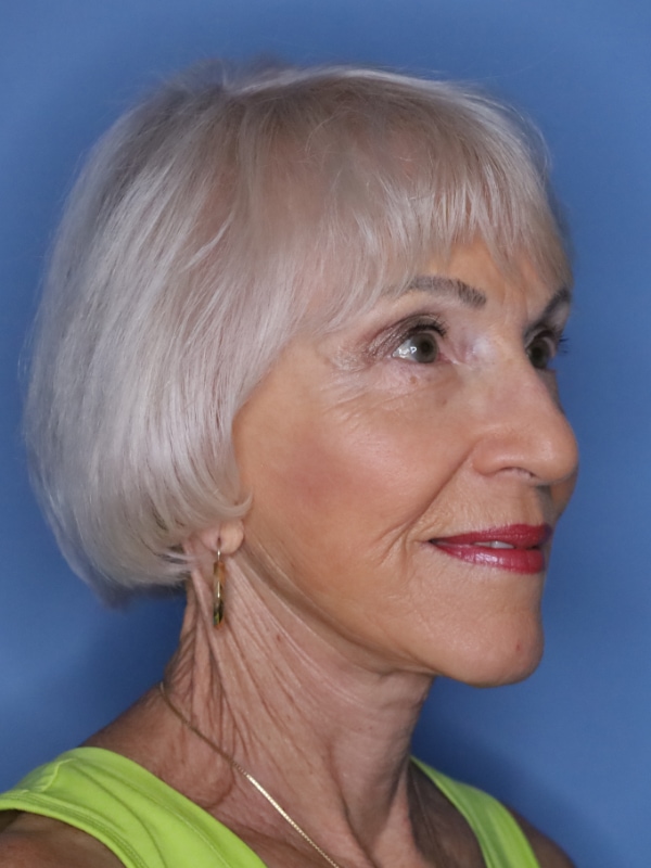 Facelift Before & After Patient 11