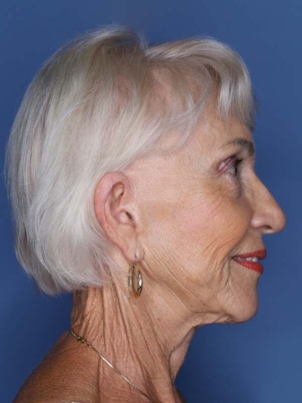 Facelift Before & After Patient 11