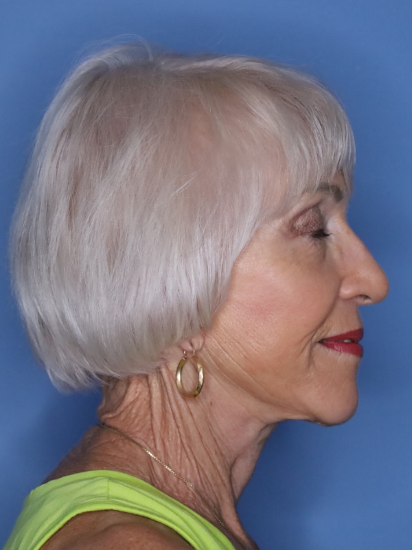 Facelift Before & After Patient 11