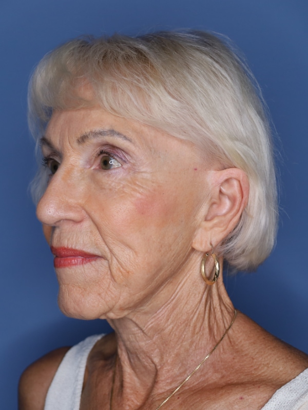 Facelift Before & After Patient 11