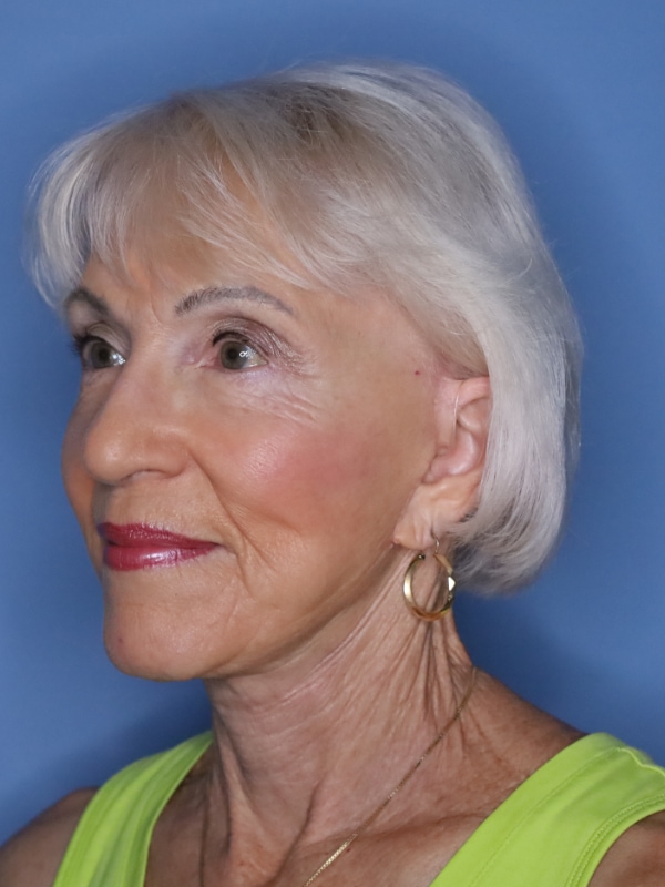 Facelift Before & After Patient 11