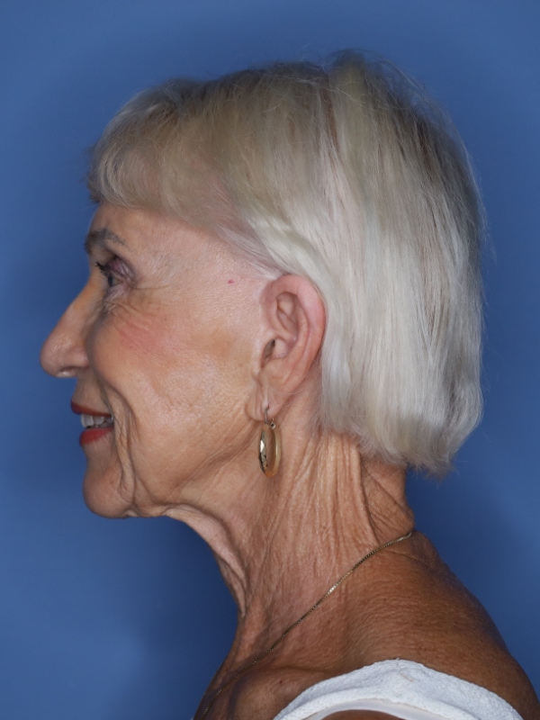 Facelift Before & After Patient 11