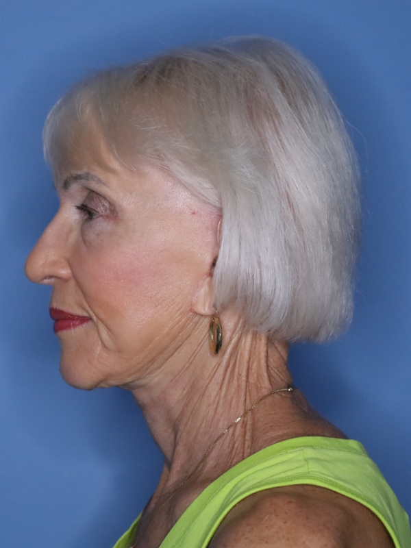 Facelift Before & After Patient 11