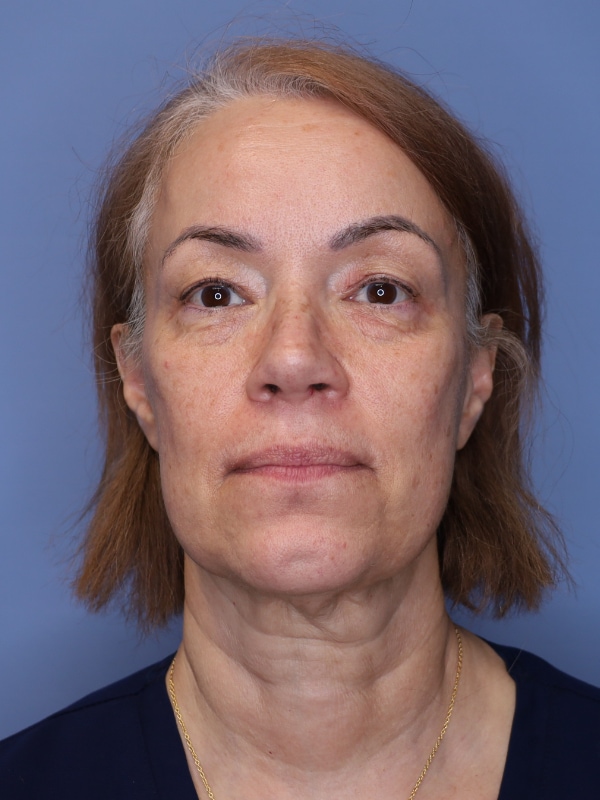 Facelift Before & After Patient 12