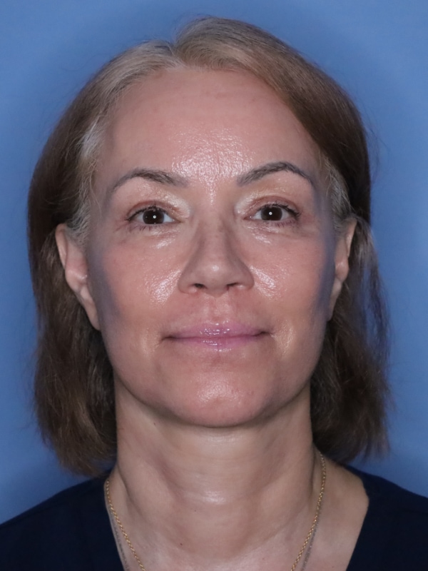 Facelift Before & After Patient 12