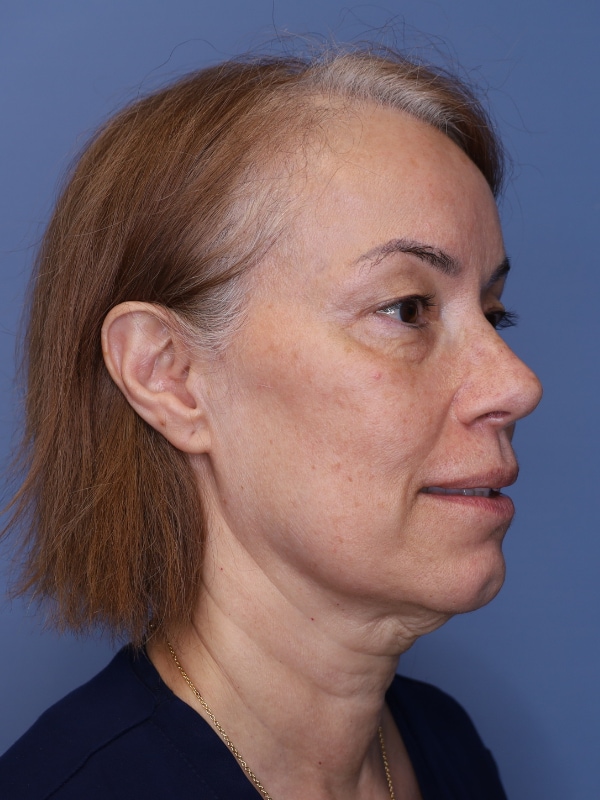 Facelift Before & After Patient 12