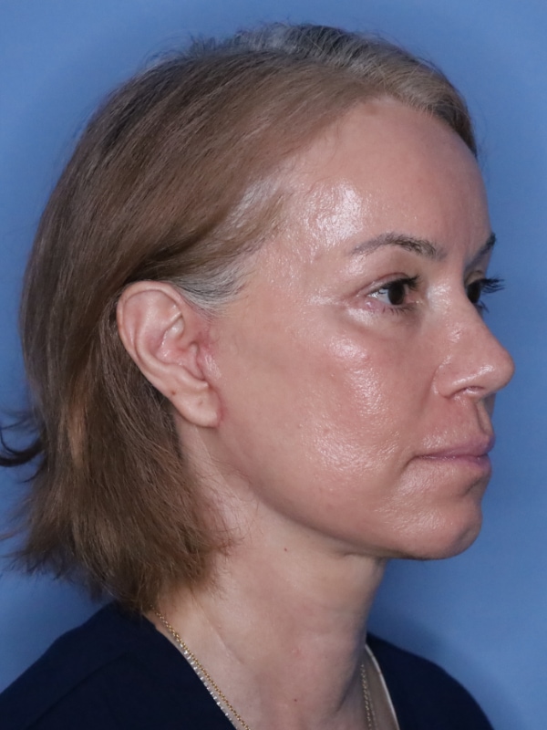 Facelift Before & After Patient 12