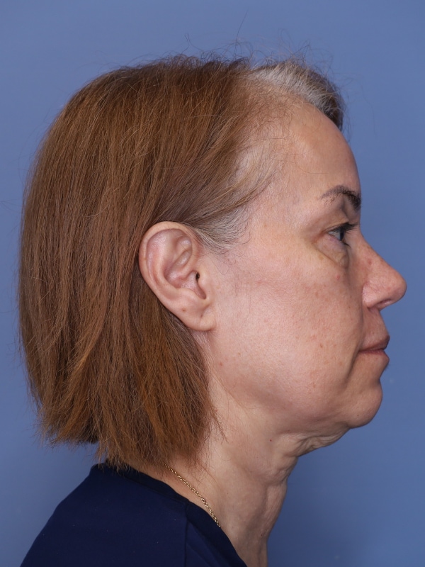 Facelift Before & After Patient 12