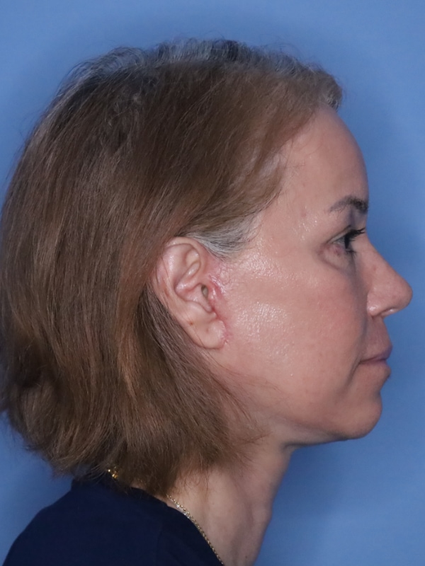 Facelift Before & After Patient 12