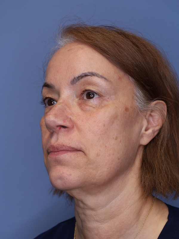 Facelift Before & After Patient 12