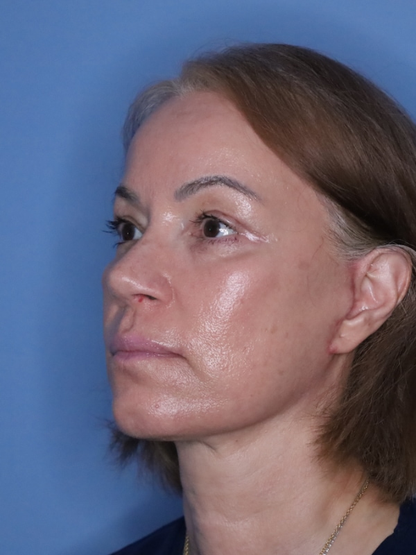 Facelift Before & After Patient 12