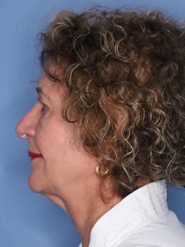 Facelift Before & After Patient 12