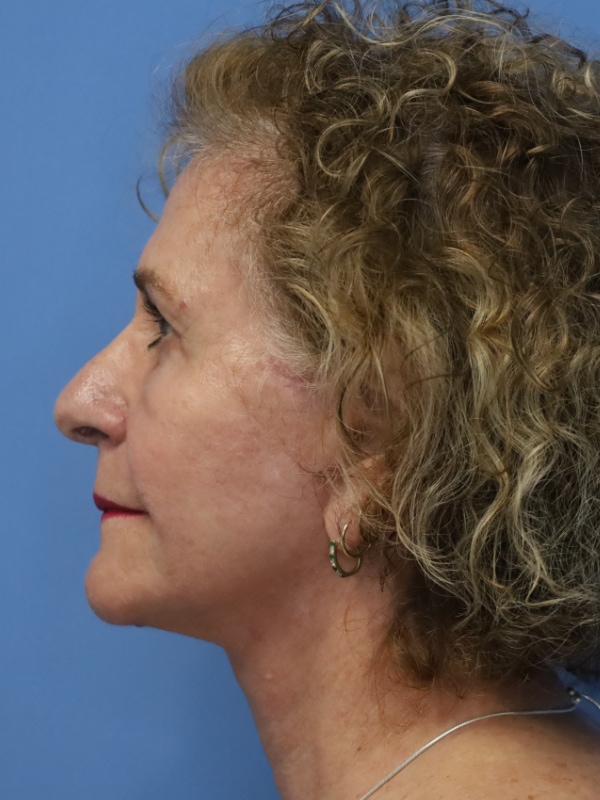 Facelift Before & After Patient 12