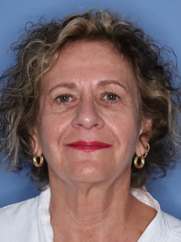 Facelift Before & After Patient 13