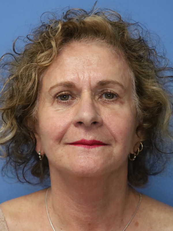 Facelift Before & After Patient 13