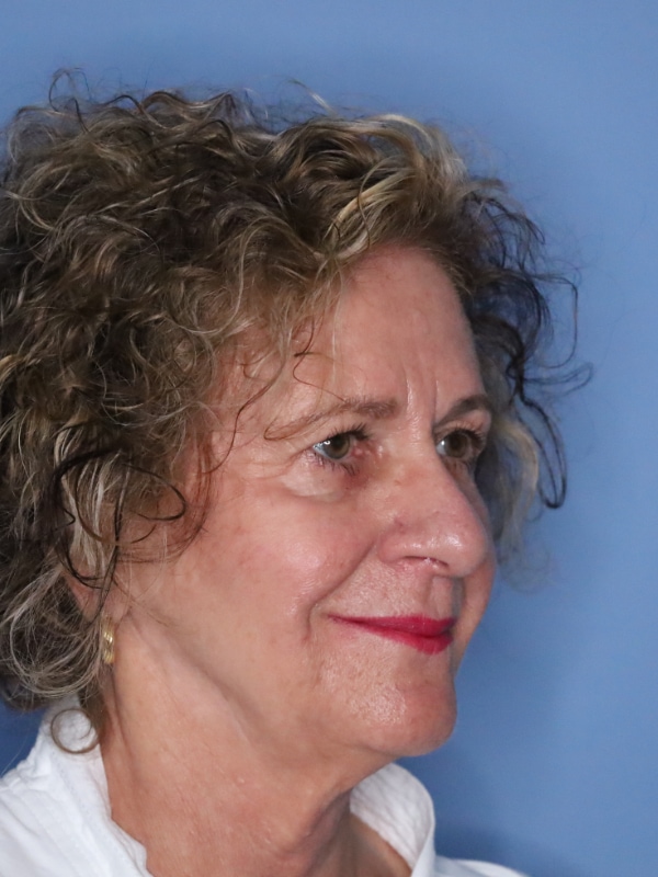 Facelift Before & After Patient 13