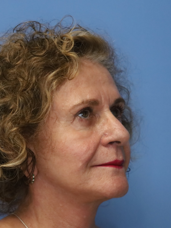 Facelift Before & After Patient 13