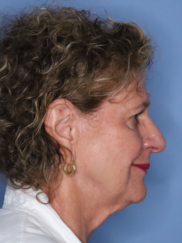 Facelift Before & After Patient 13