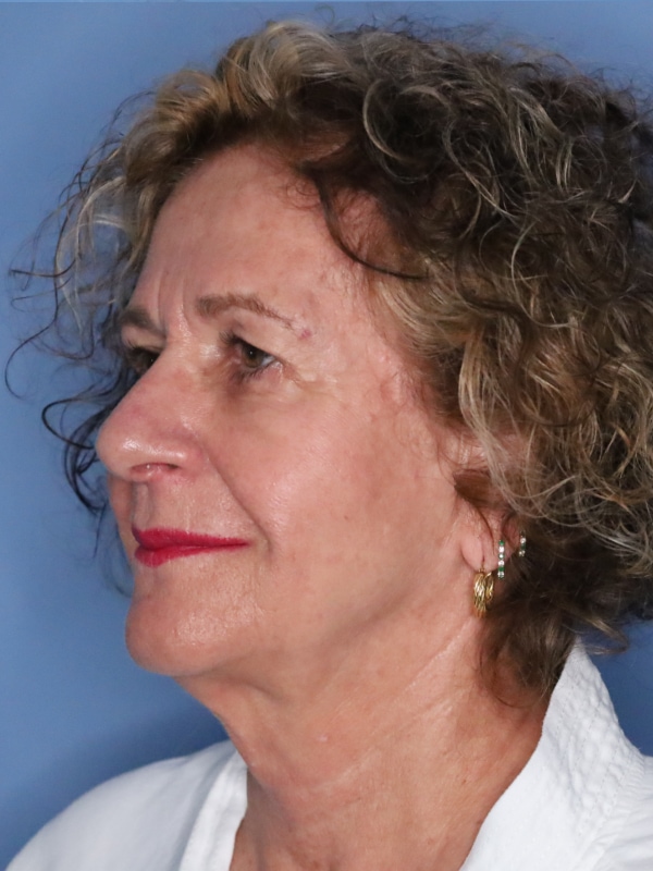 Facelift Before & After Patient 13