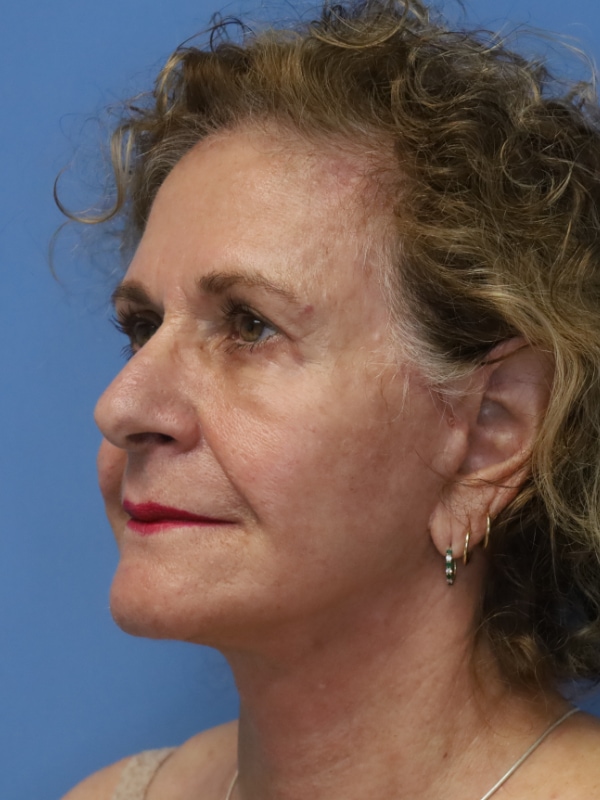 Facelift Before & After Patient 13