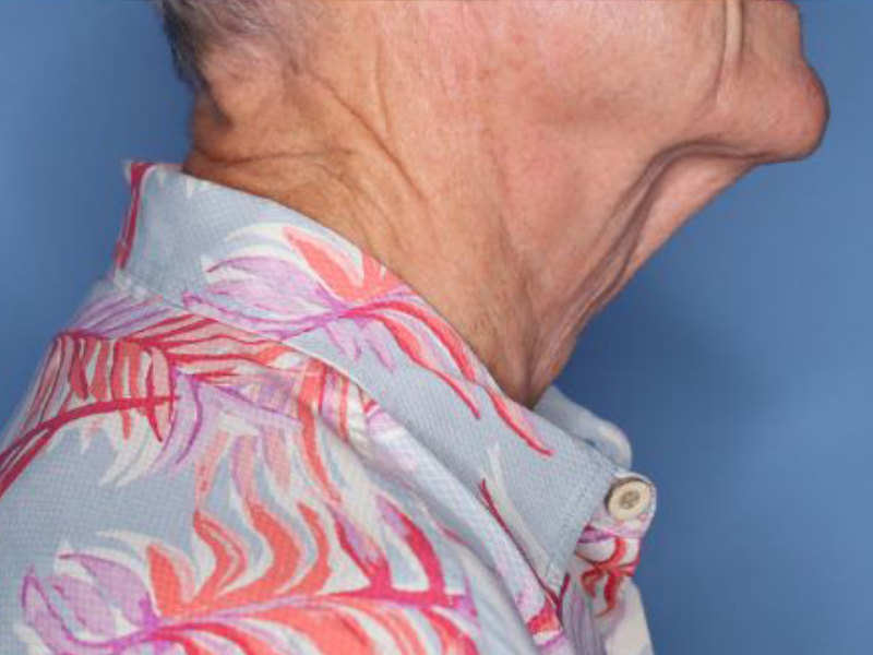 Facelift Before & After Photo Patient 14 Thumbnail