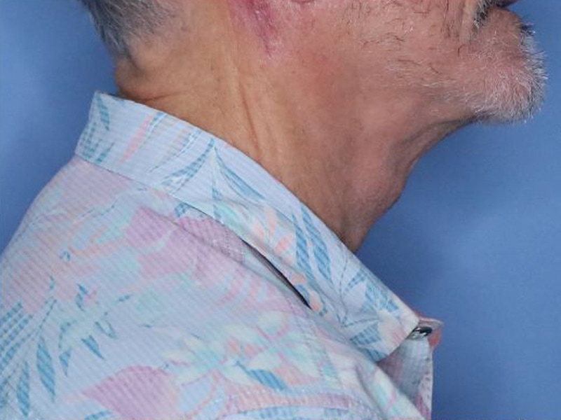 Facelift Before & After Photo Patient 14 Thumbnail