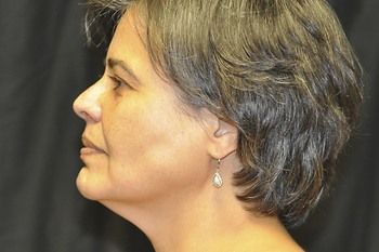 Neck Lift Before & After Patient 01