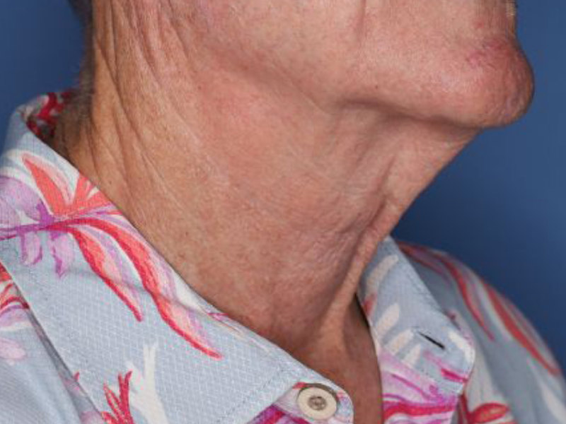 Neck Lift Before & After Patient 02