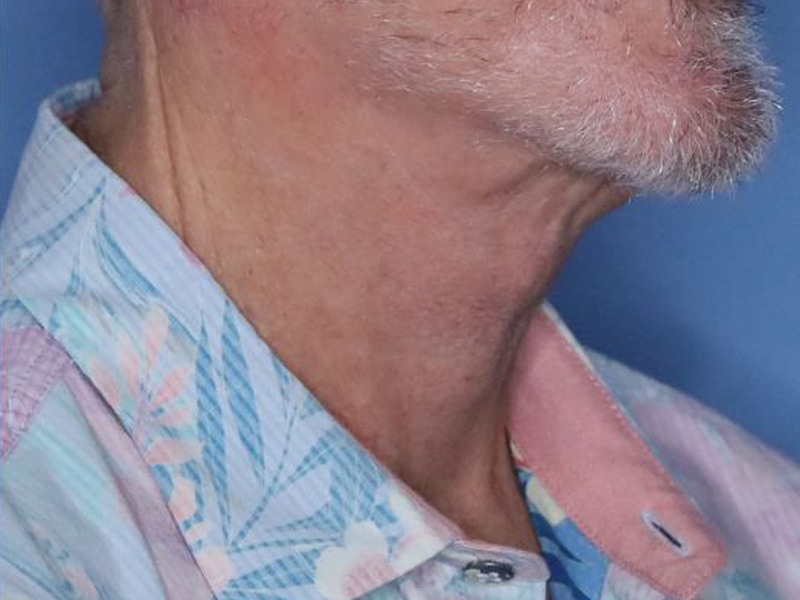 Neck Lift Before & After Patient 02