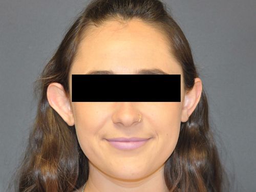 Otoplasty Before & After Photo