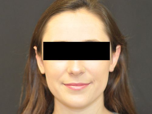 Otoplasty Before & After Photo